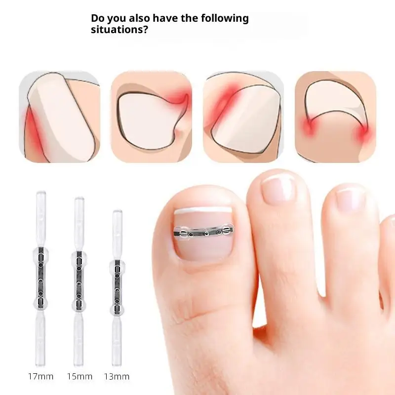 Corrector de uñas encarnadas, herramientas para pedicura, recuperación integrada, tratamiento de uñas de los pies, soporte profesional para alisar uñas encarnadas