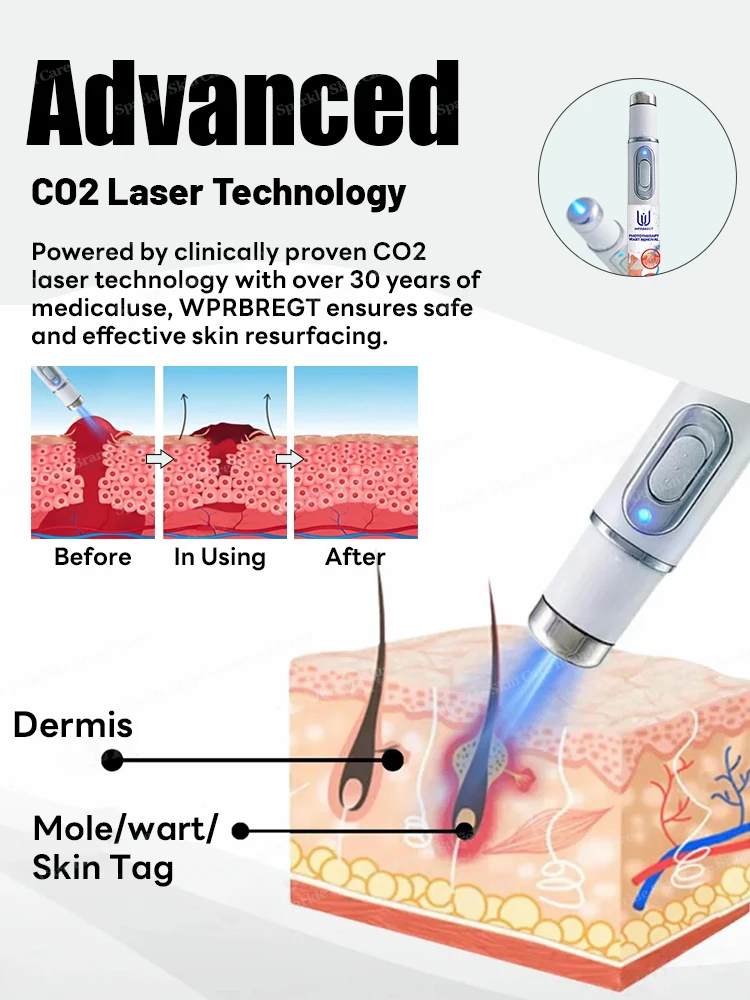 The first generation of improved  ᴡᴀʀᴛ ʀᴇᴘᴀɪʀ ᴀɢᴇɴᴛ ᴡᴀʀᴛ ʀᴏᴏᴛ ғᴀsᴛ