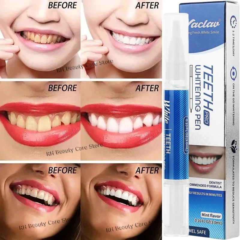 قلم تبييض الأسنان قلم تبييض الأسنان الأبيض المبهر قلم تبييض الأسنان الفوري أدوات العناية بصحة الأسنان #3