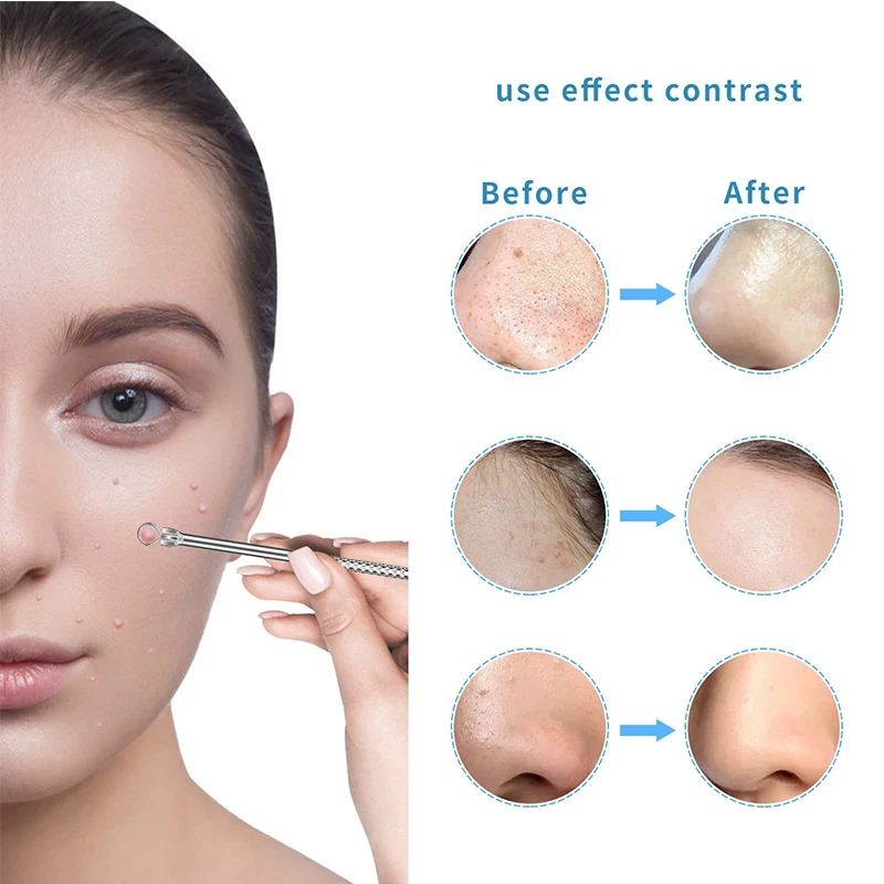 Kit removedor de cravo de aço inoxidável, 15 peças, conjunto de ferramentas de espinhas com extrator de comedone, pinças de acne, agulhas de beleza para cuidados faciais