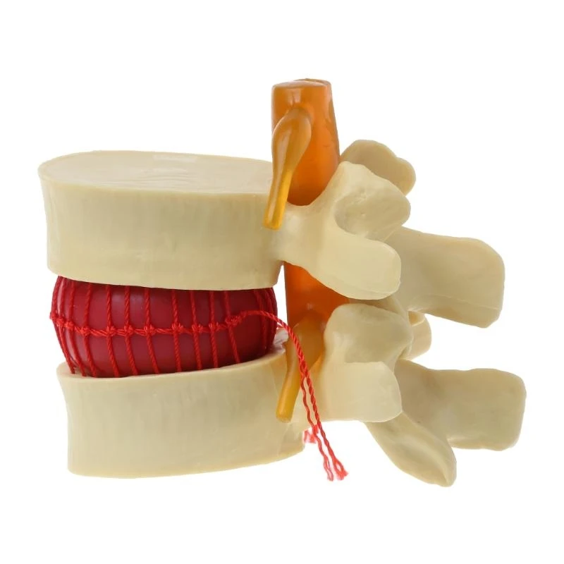 W89C Human Anatomy Skeleton Spine Lumbar Disc Herniation Teaching Model Spinal Lesions Medical Teaching Tool Props