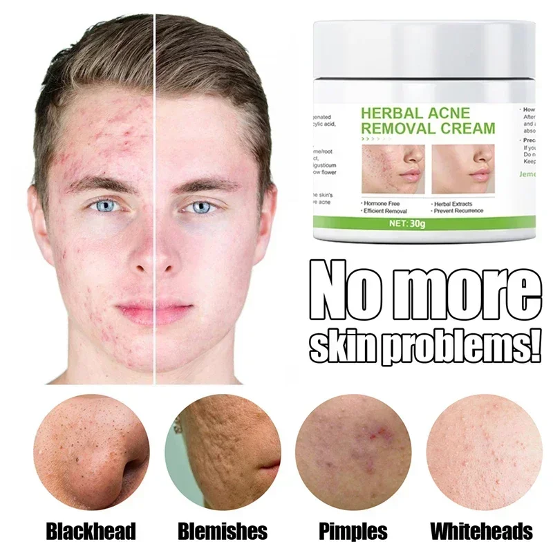 Líquido Eficaz para Remoção de Acne, Solução Conveniente para Reparação Facial, Produtos Suaves para Cuidados com a Pele, Confortável