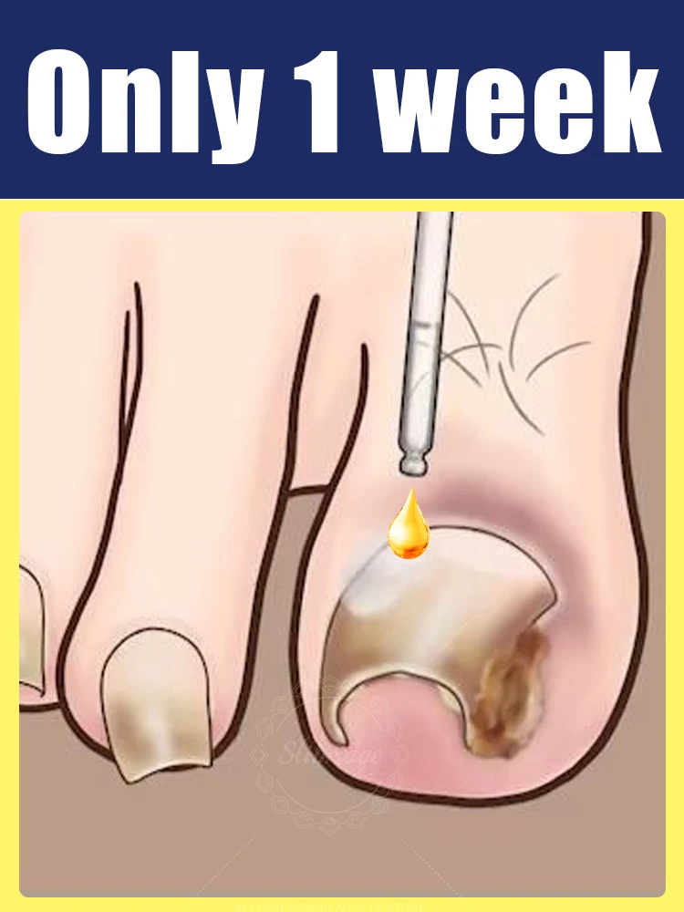 Foot Care Tools Cleaning Nail Say Goodbye To Bad Nail In 7 Days