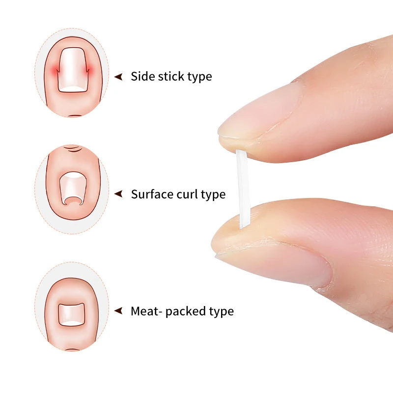 Patch Autocollant artificiel astique pour Traitement des Ongles Incarnés, Pince à Redresser, Outils de Pédicure, 50 Pièces