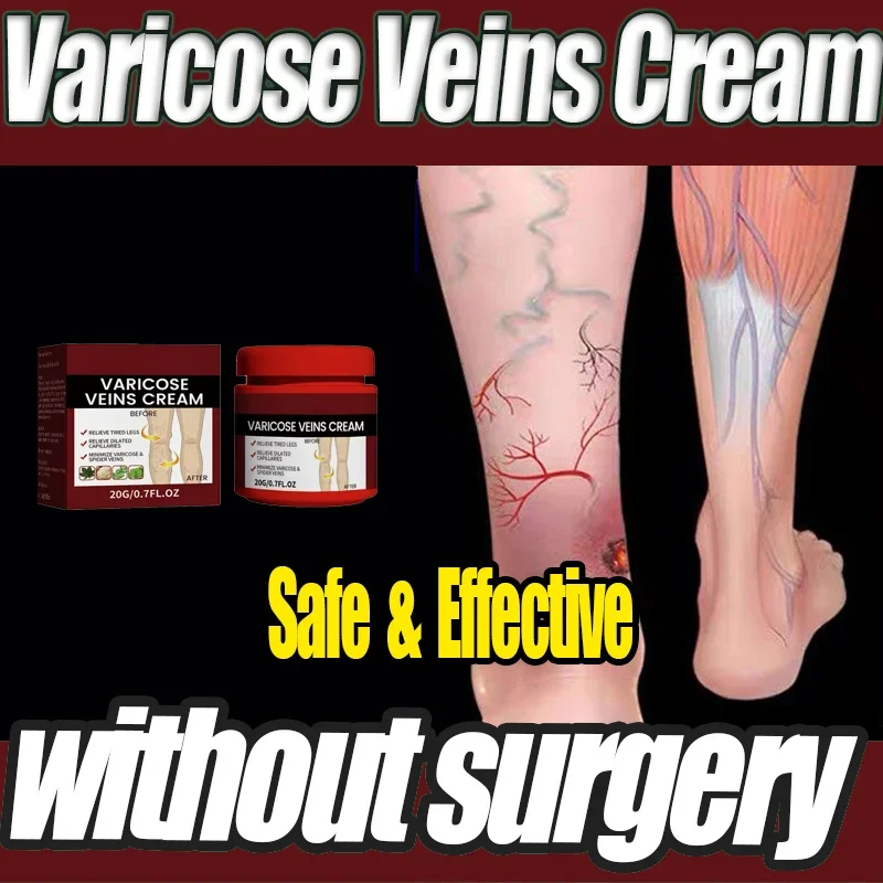 

Varicose Veins Effective Varicose Vein Relief To Relieve Vasculitis Phlebitis Spider Pain Treatment Foot Care2024