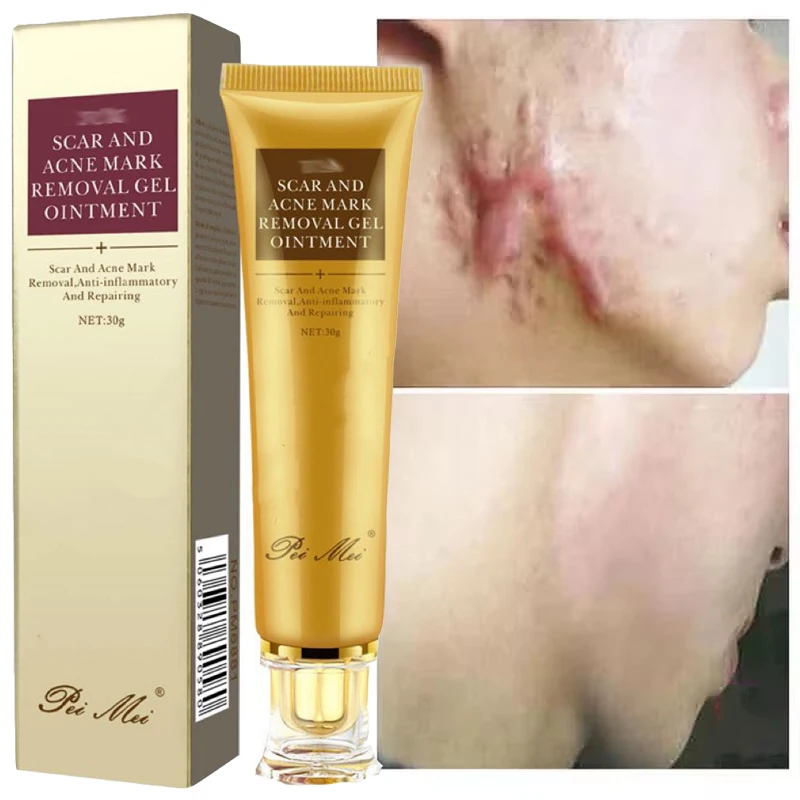 Fast Scar Removal Cream Effective Treatment Stretch Marks Burn Surgical Scars Acne Spot Repair Whiten Moisturize Herbal SkinCare