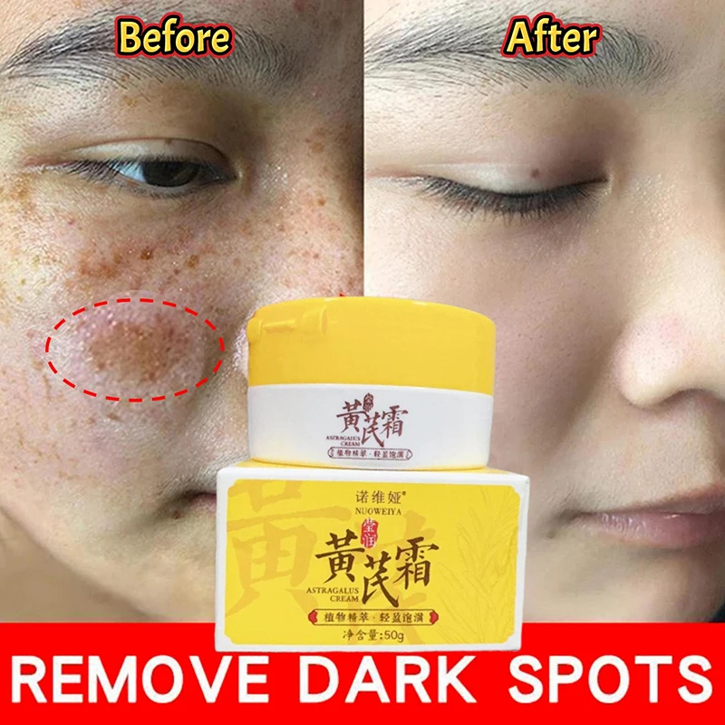 Astragalus Whitening Freckles Cream Face Dark Spots Remover Repair Products Removal Melasma Melanin Moisturiz Brighten Skin Care