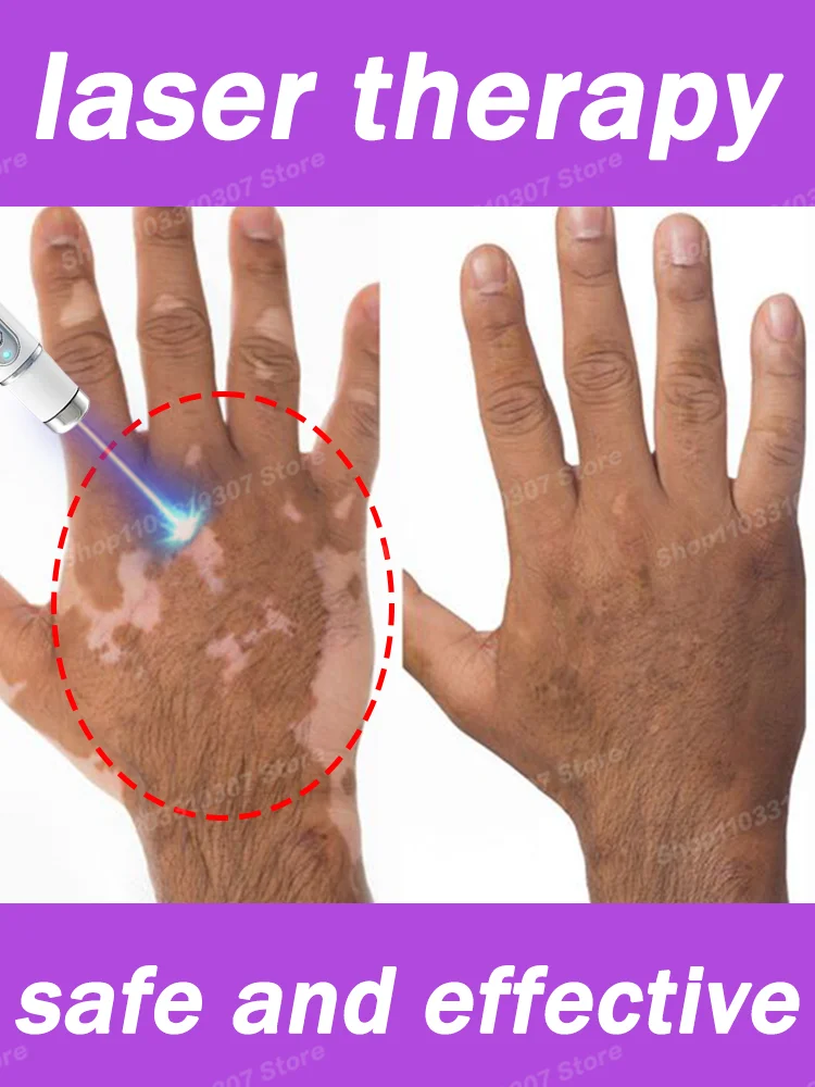 

Improve Skin Pigmentation and Reduce White Spots Vitiligo Treatment