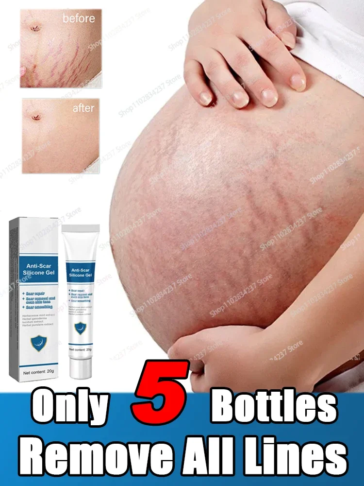 Stretch Mark Removal Cream Permanently Removes Stretch Marks Rejuvenates Skin 1