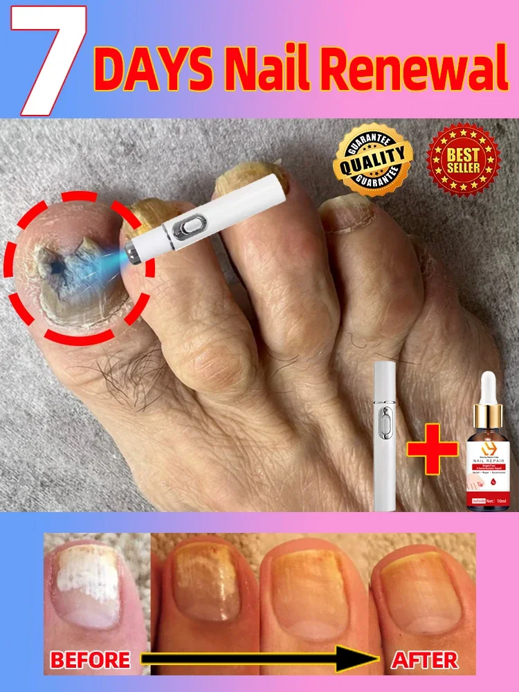 Laser Product For Solving Nail Problems