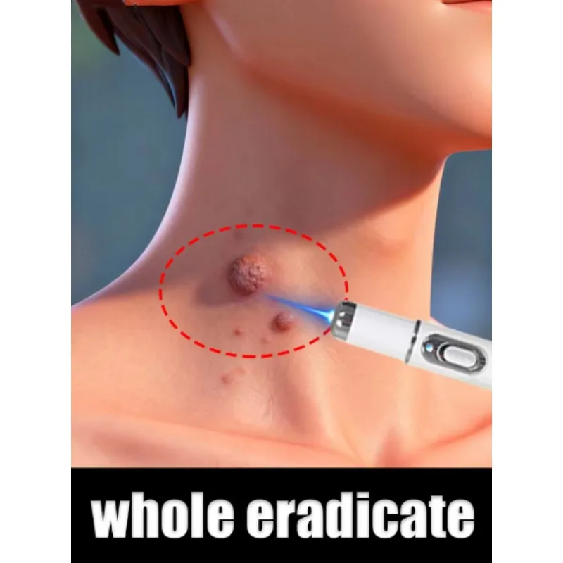 

Wart Care Kit for Perennial Warts blue light pen