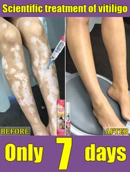 Traitement au laser du vitiligo. Éliminer les taches blanches