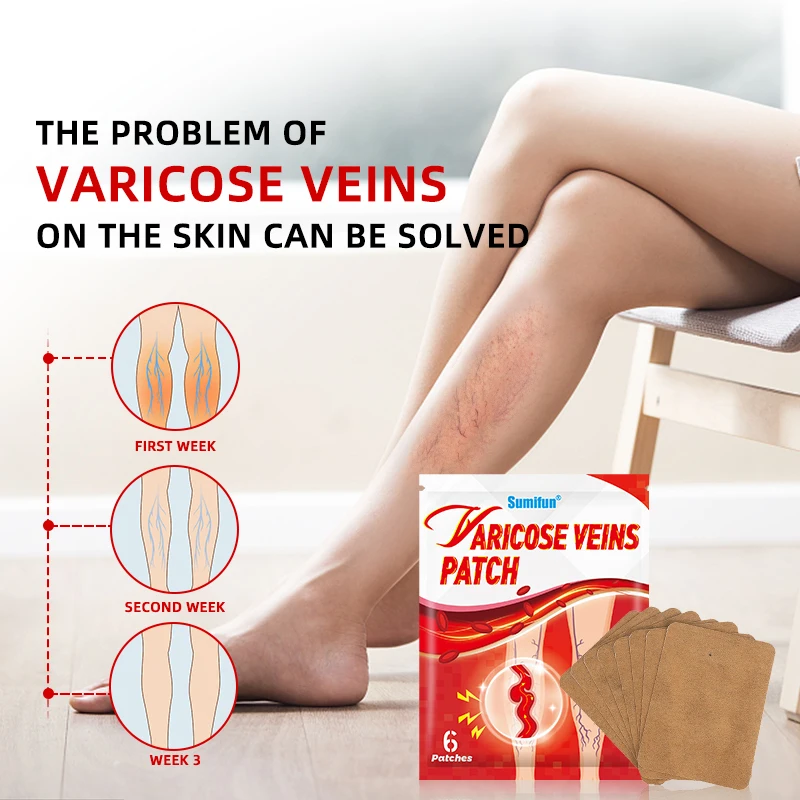 30Pcs Sumifun Varicose Veins Patch Spider Vein Legs Treatment Plaster Vasculitis Tired Anti Swelling Angiitis Chinese Medicine