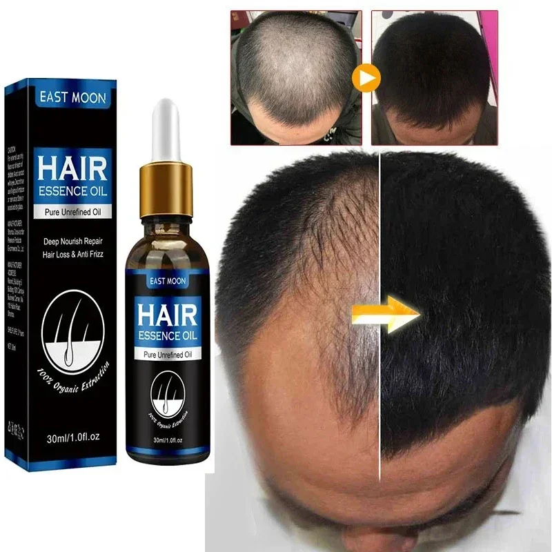 Hair Growth Oil Effective Repair Hereditary Hair Loss Follicle Seborrheic Hair Loss Postpartum Hair Loss Fast Repair Baldness