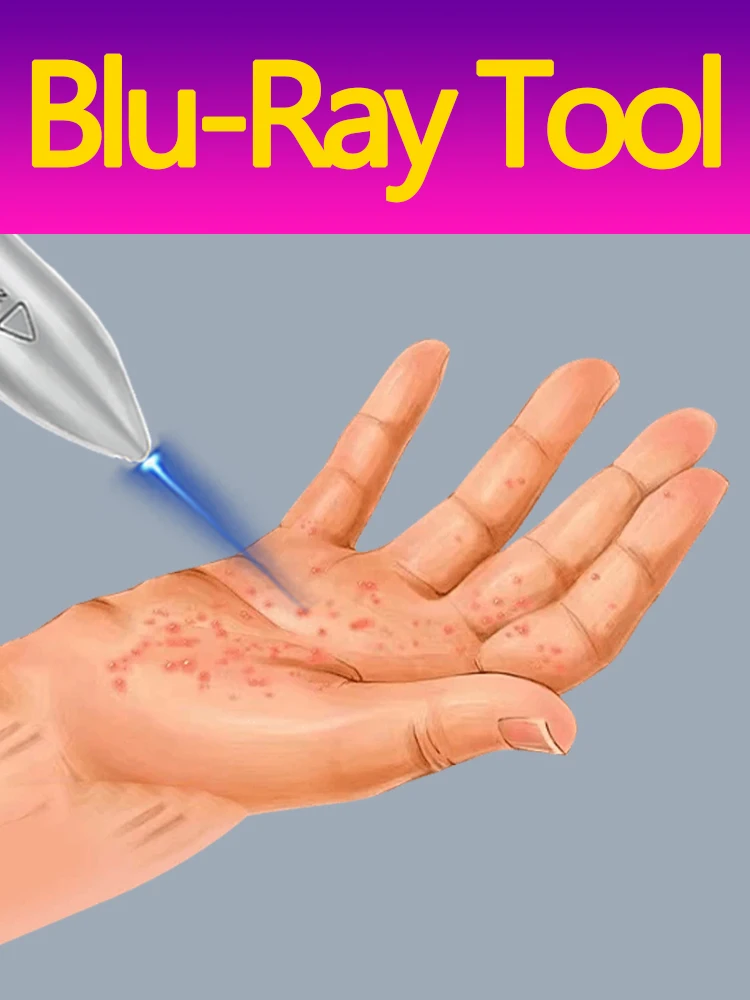 

Hot sale solve warts tweezers tool. Blue light tool pen
