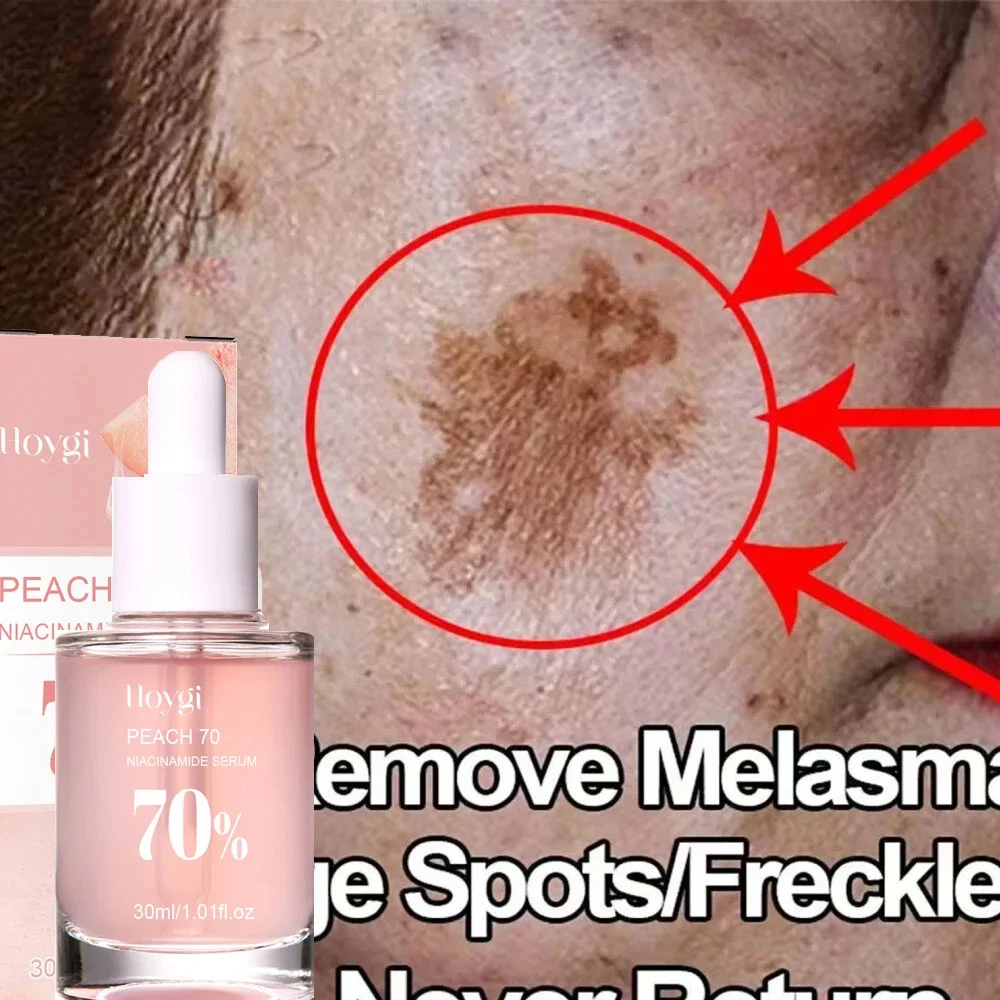 

Niacinamide Whitening Freckles Serum Removal Melasma Dark Spots Lighten Melanin Pigmentation Brightening Nourishing Skin Care