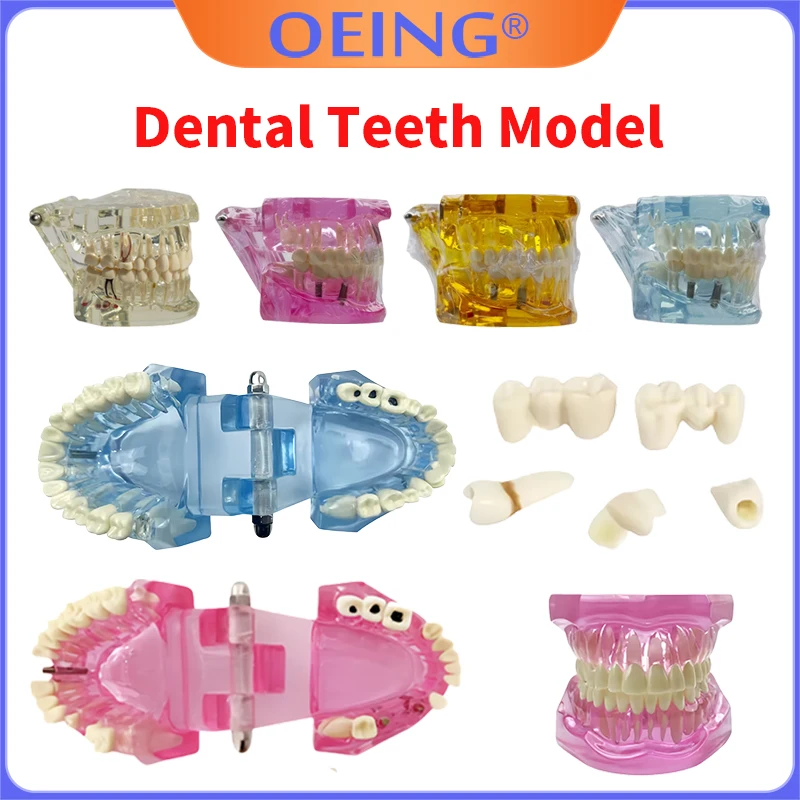 1Pcs Teeth Model Implant Disease Dentist Studying Model Dental Typodont Model With Removable Teeth Restoration Bridge