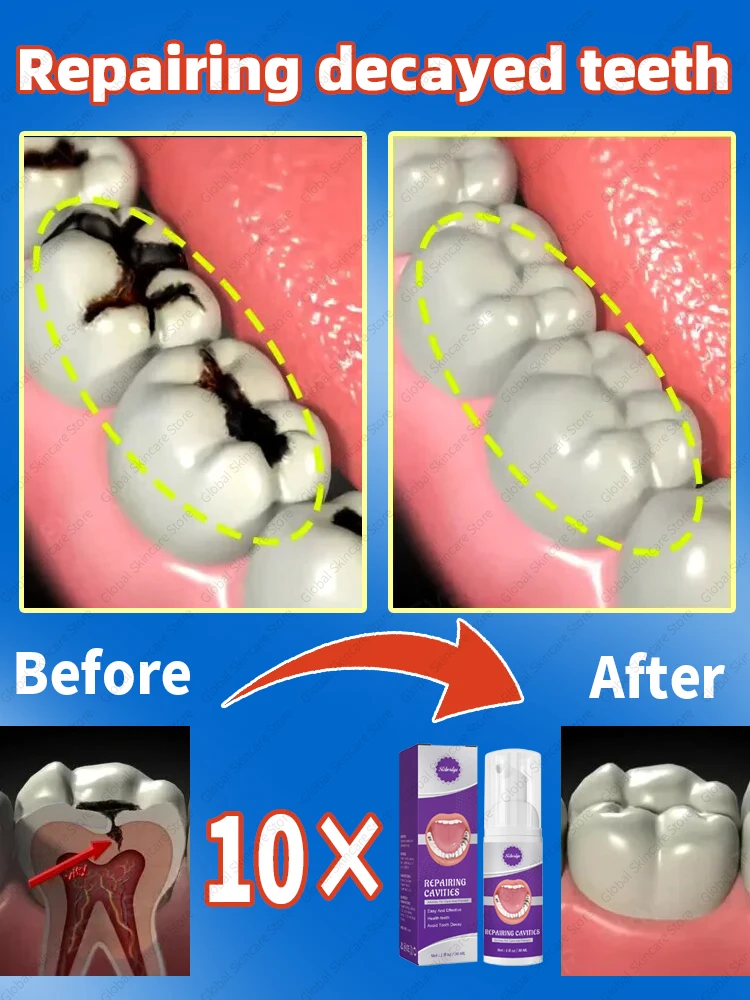 Risoluzione di carie e problemi di carie dei denti