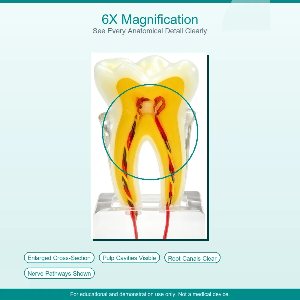 Disease Teeth Model 6 Times Dental Caries Model for Dentals Demonstration Model Dentist Teaching Dental Lab Oral Research
