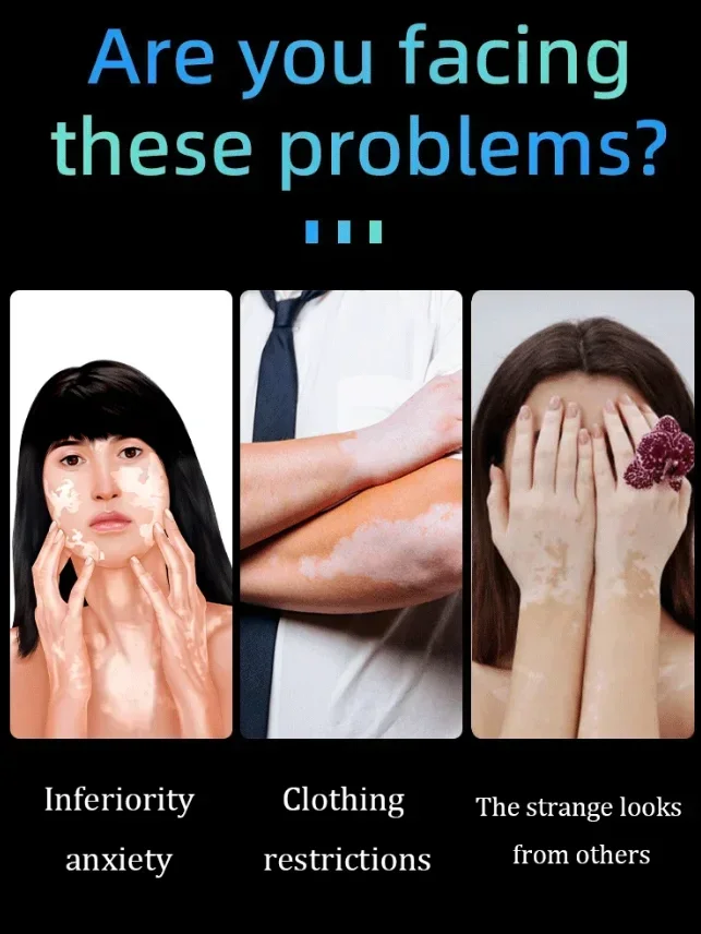 il laser blu migliora il vitiligine, strumenti infermieristici di vendita caldi 2025