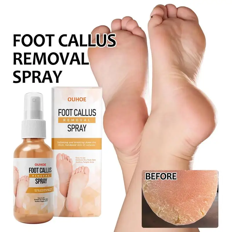 Spray dissolvant de callosités pour les pieds, adoucit rapidement les callosités, exextinction des pieds secs, peau hydratante, fréquence des pieds, soin des pieds, 30ml