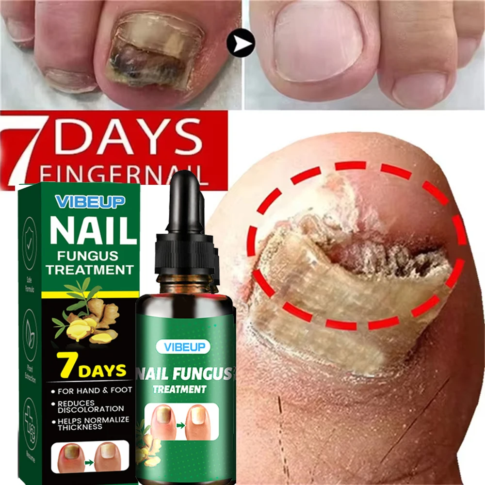 7일 곰팡이 발톱 치료 세럼 발톱 곰팡이 제거 복구 젤 항균 감염 발톱 주위염 발톱 진균증 발톱 관리