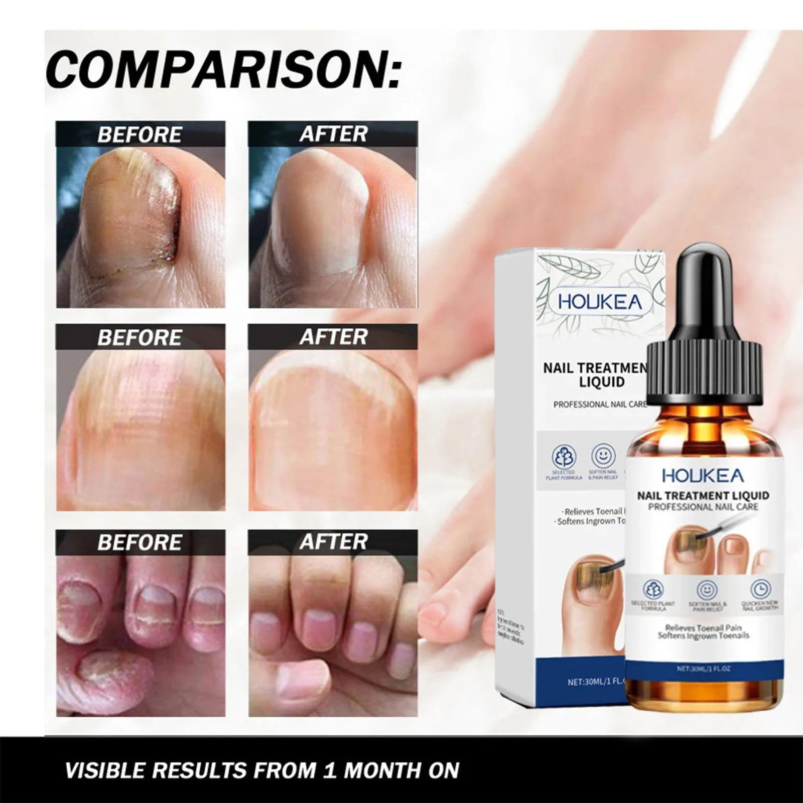 Esencja na grzybicę paznokci usuwająca infekcje grzybieniowe paznokci, regenerująca zniszczone paznokcie u stóp, produkt do pielęgnacji paznokci.