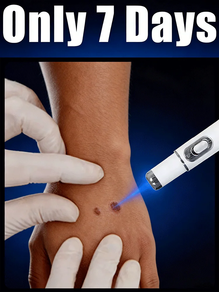 

Самая продаваемая ручка от бородавок с синим светом: эффективна для удаления и ухода за бородавками на теле