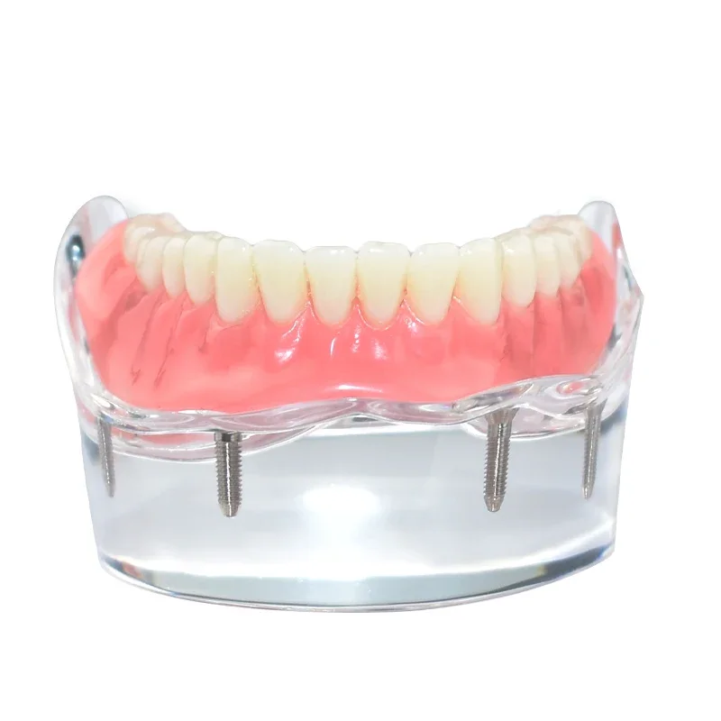 نموذج لشكل الأسنان M6003 مع زرع الأسنان الزائدة التجريبي السفلي للفك السفلي من الأكريليك الشفاف يسمح قاعدة الفك السفلي