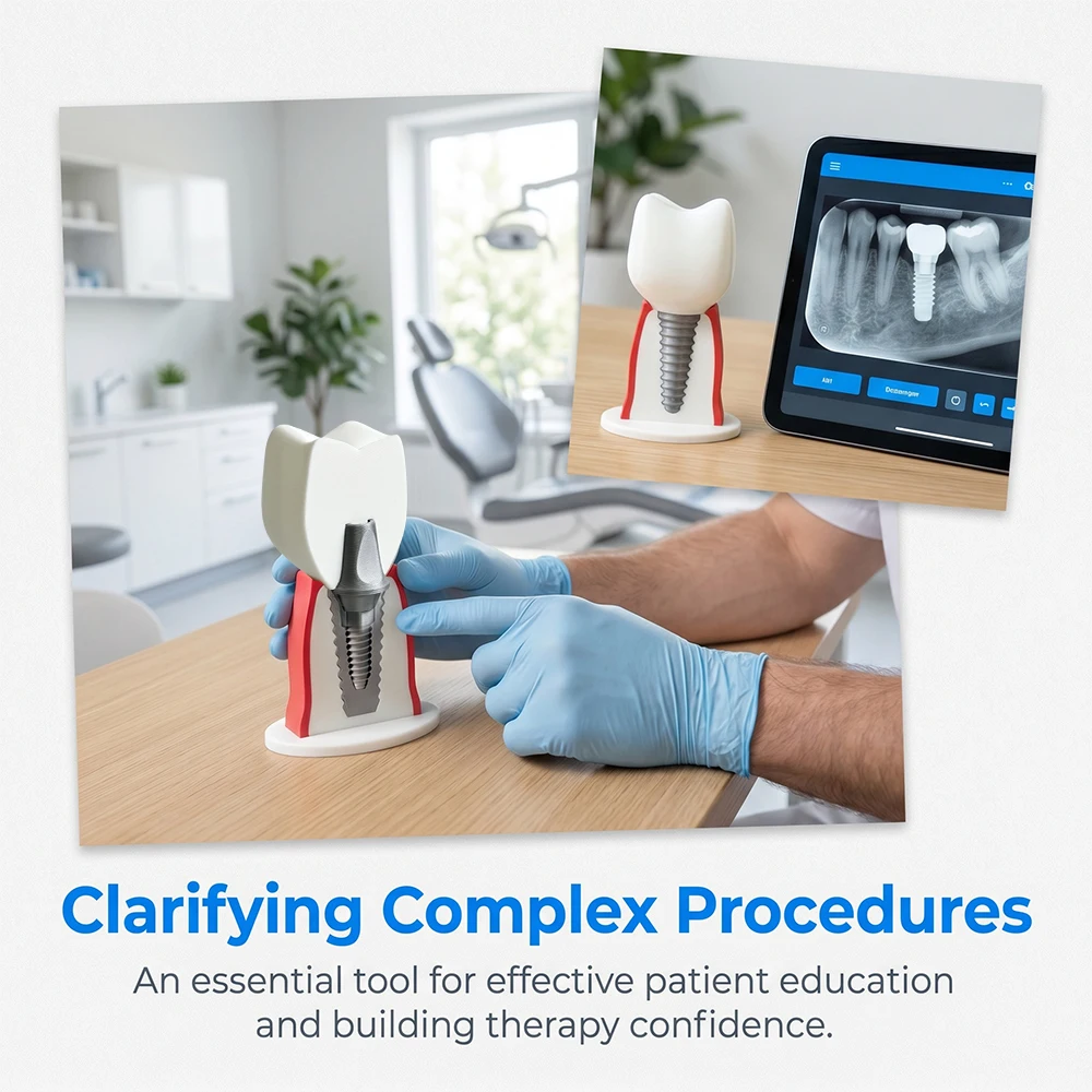 Detachable Dental Implant Model with Screw Implant Crown Abutment Fixture Display Model for Dental School Training Display Model