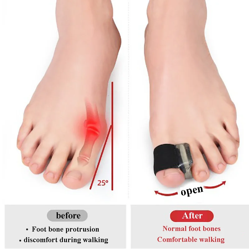 4/2/PCS Toe Separator Hallux Valgus Bunion Corrector Orthotics Feet Bone Adjuster Big Toe Straightener Pedicure Foot Care Tools
