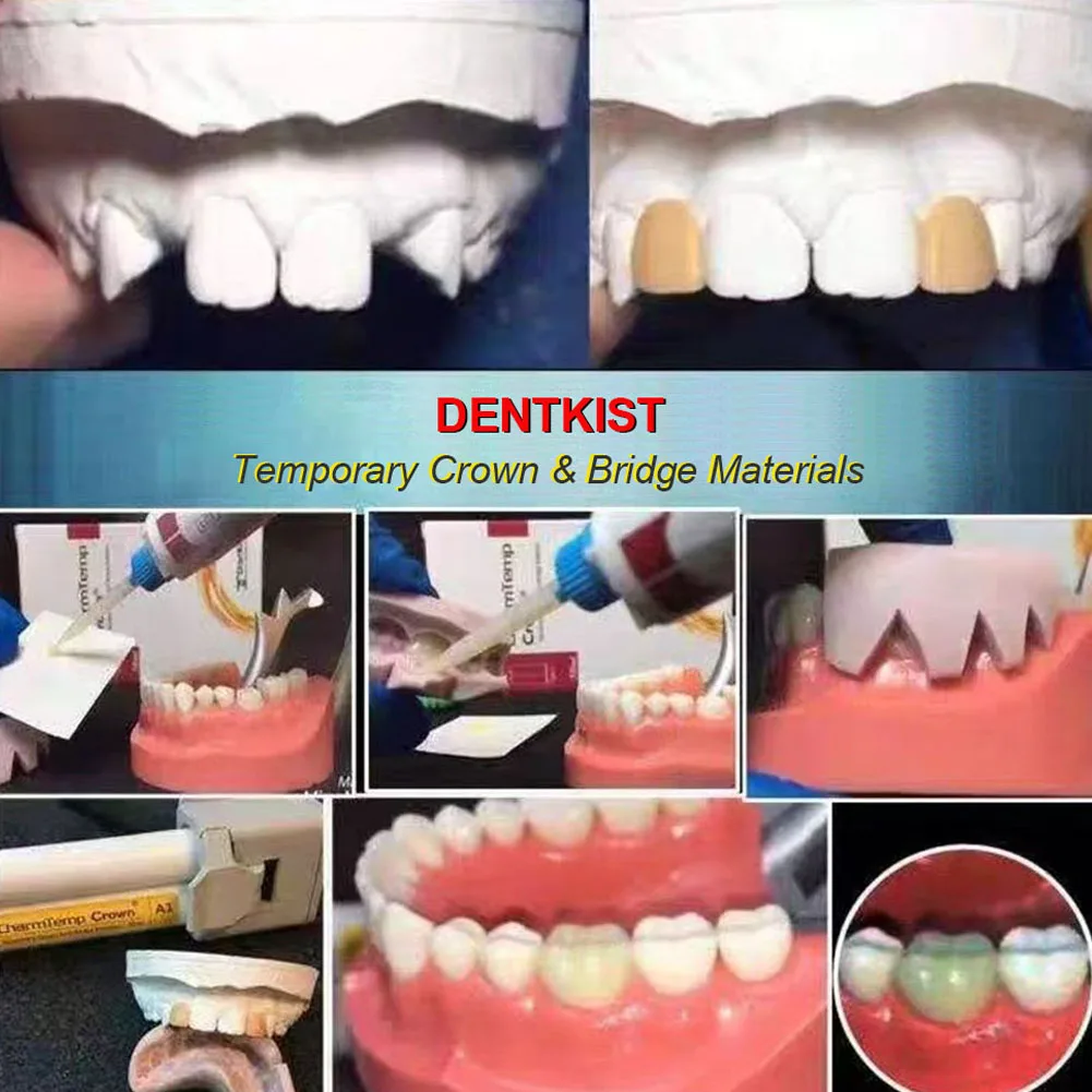 DENTKIST CharmTemp Crown Temporary Veneer Bridge Materials 50ml Catalyst Paste Cartridge Self Curing Dental Dispensing Mix Tips