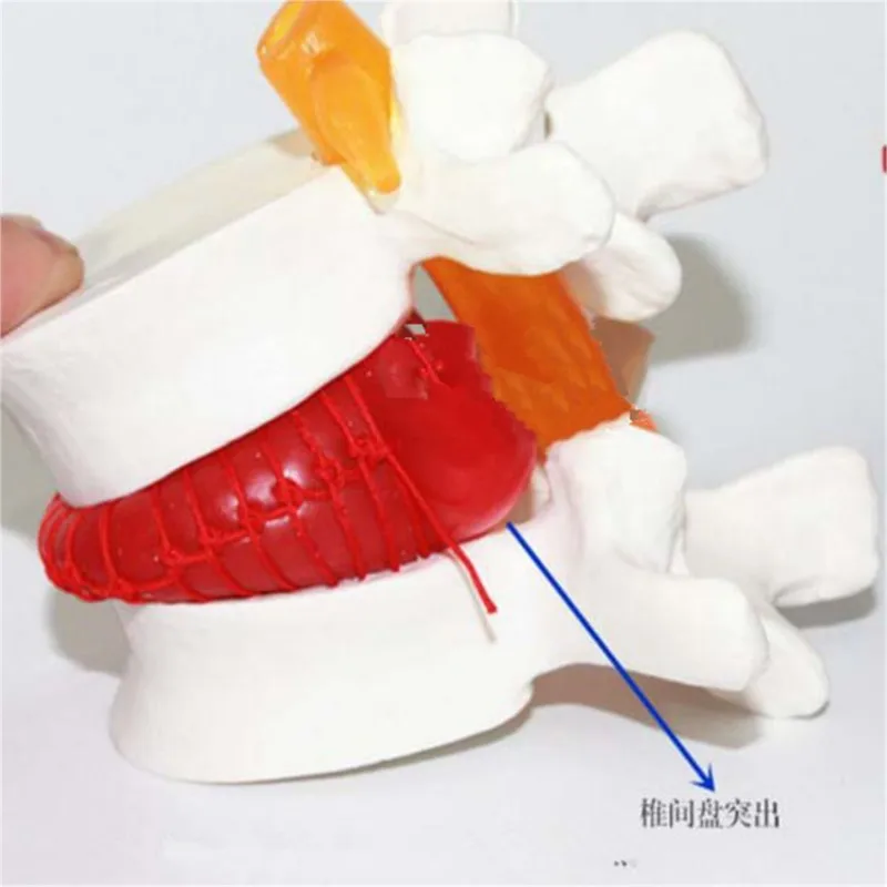 Human Lumbar Disc Herniation Model Demonstration Model of Lumbar Vertebral Spine Model Medical Teaching Resources