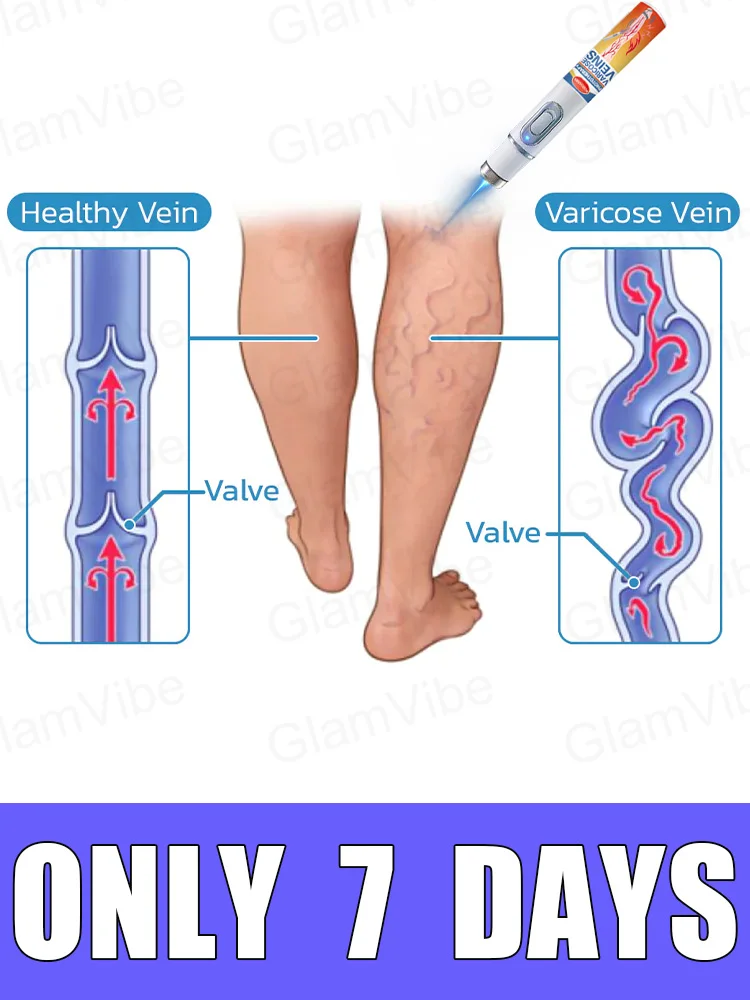 

Leg care tools, blue light pen, varicose veins, 2025 hot sale