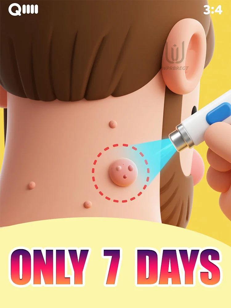 

Generation-3 Laser Says Goodbye To Wart Remove Quickly