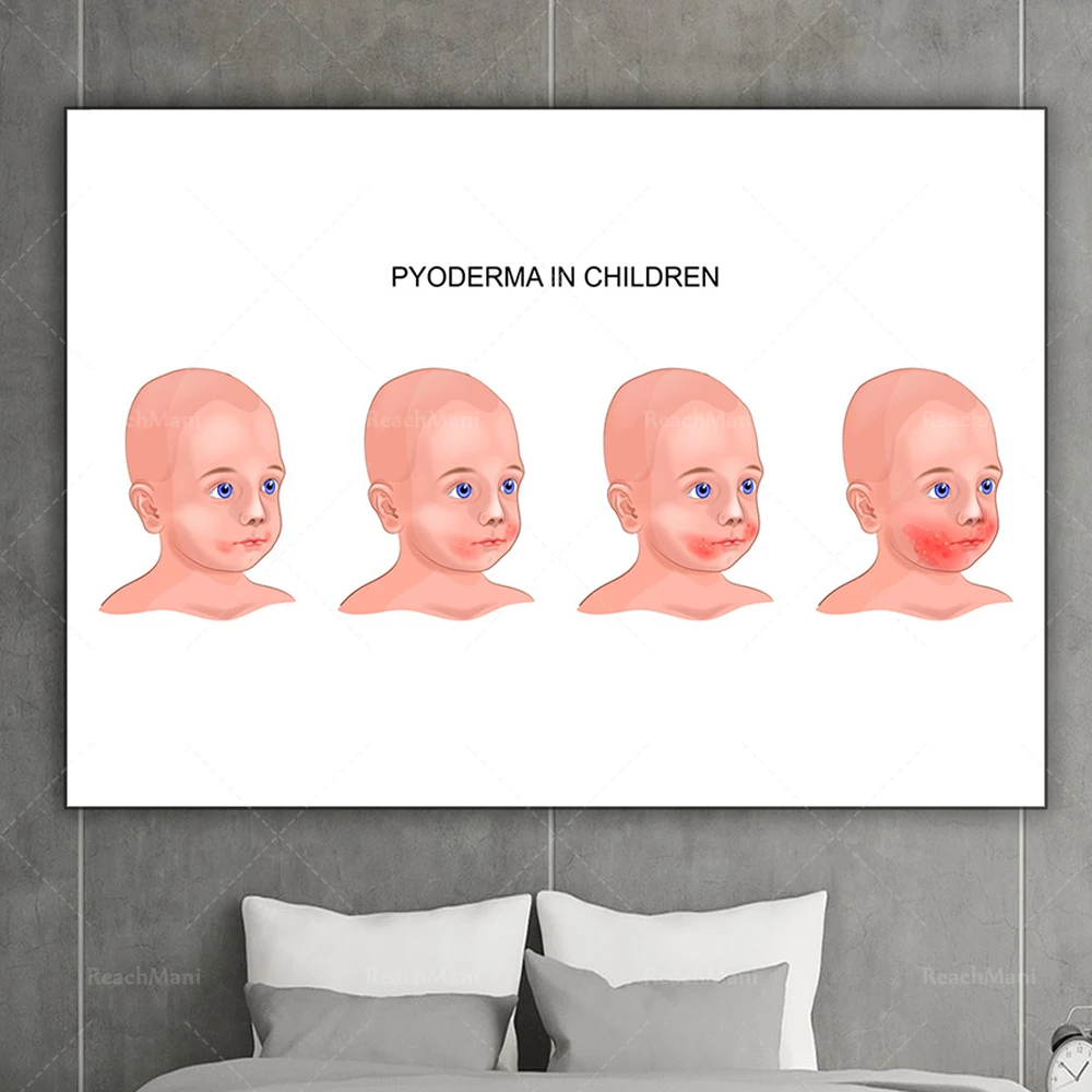 Pyoderma on baby face vector image decorative canvas print poster