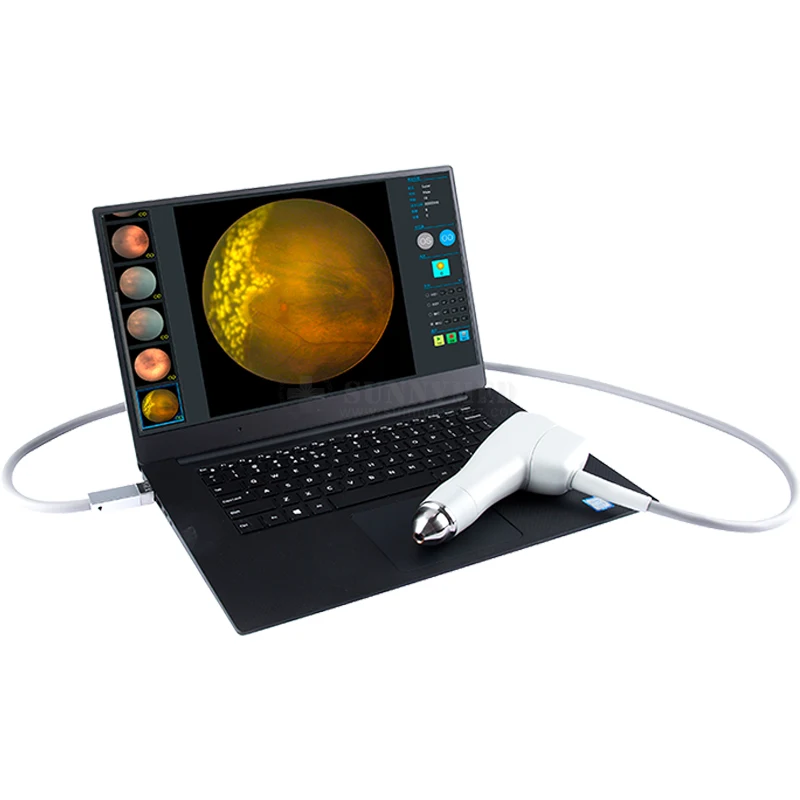 SY- V095 Pediatric Angiography of Retinopathy For Color Retinal  Ophthalmic