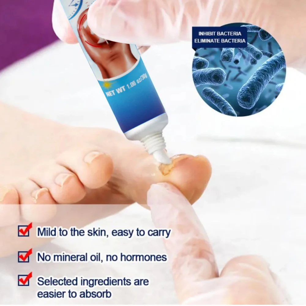 30g Nail Fungus Ointment Fungal Infection Nails Cream Feet Anti Removal Onychomycosis Paronychia Toe Repair Essence Herbal Cream - view 4