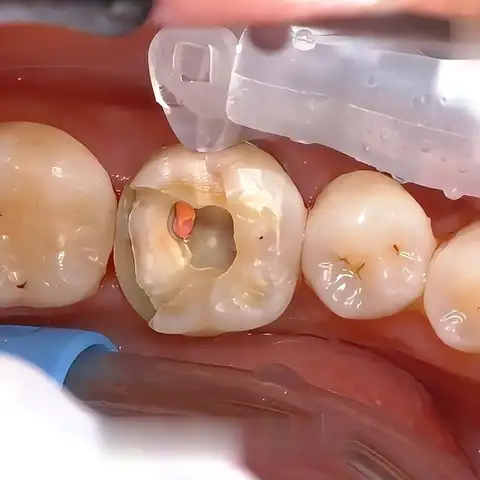 5pcs Dental Pre-Formed Retainer Matrix Band M5 Roll Type for Class II Restoration/Deep Caries, Gingival Margin Elevation