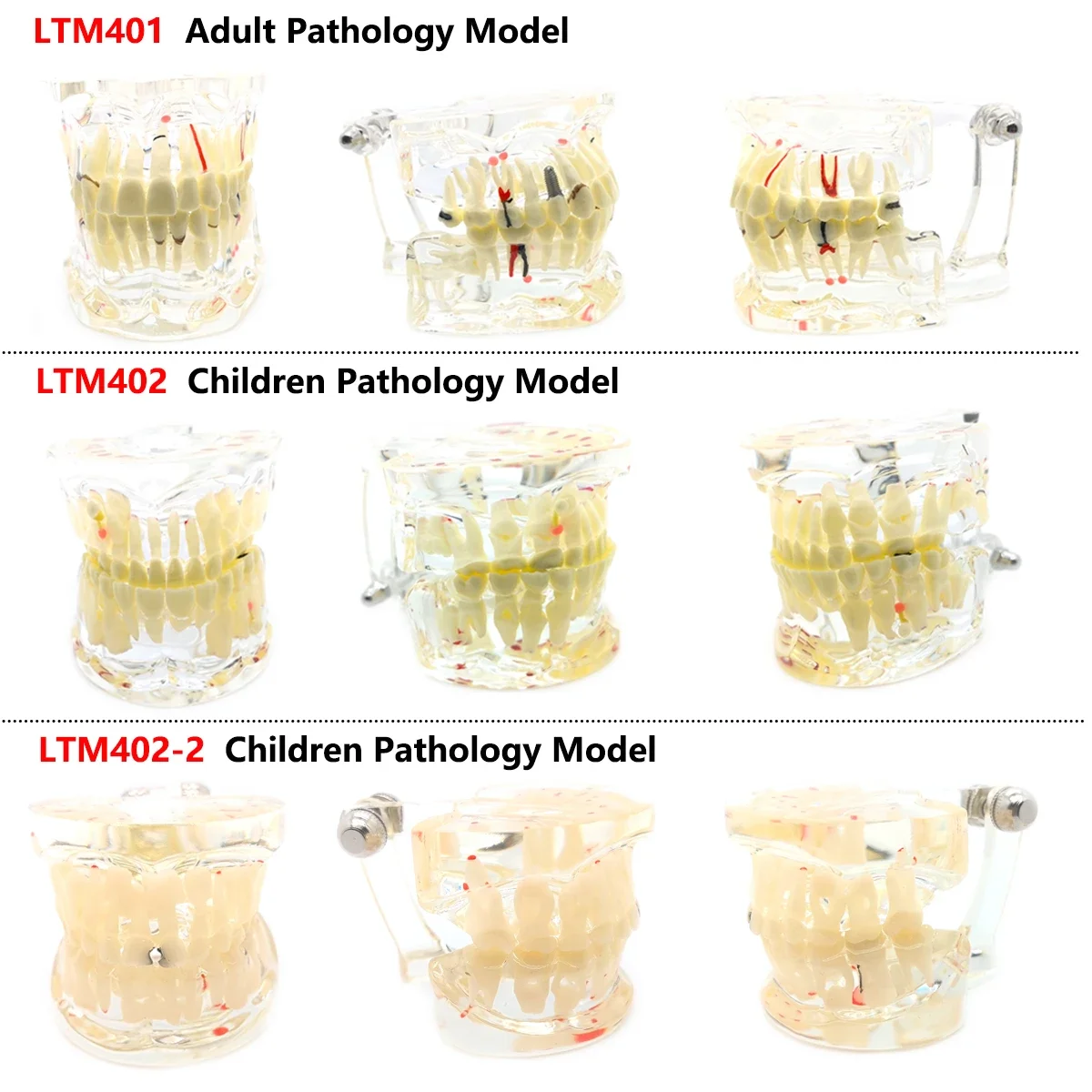 Teeth Model (Adult&Children )Carious Cysts Pathology For Dentistry Dental Teaching Demo Dental Laboratory Transparent Material