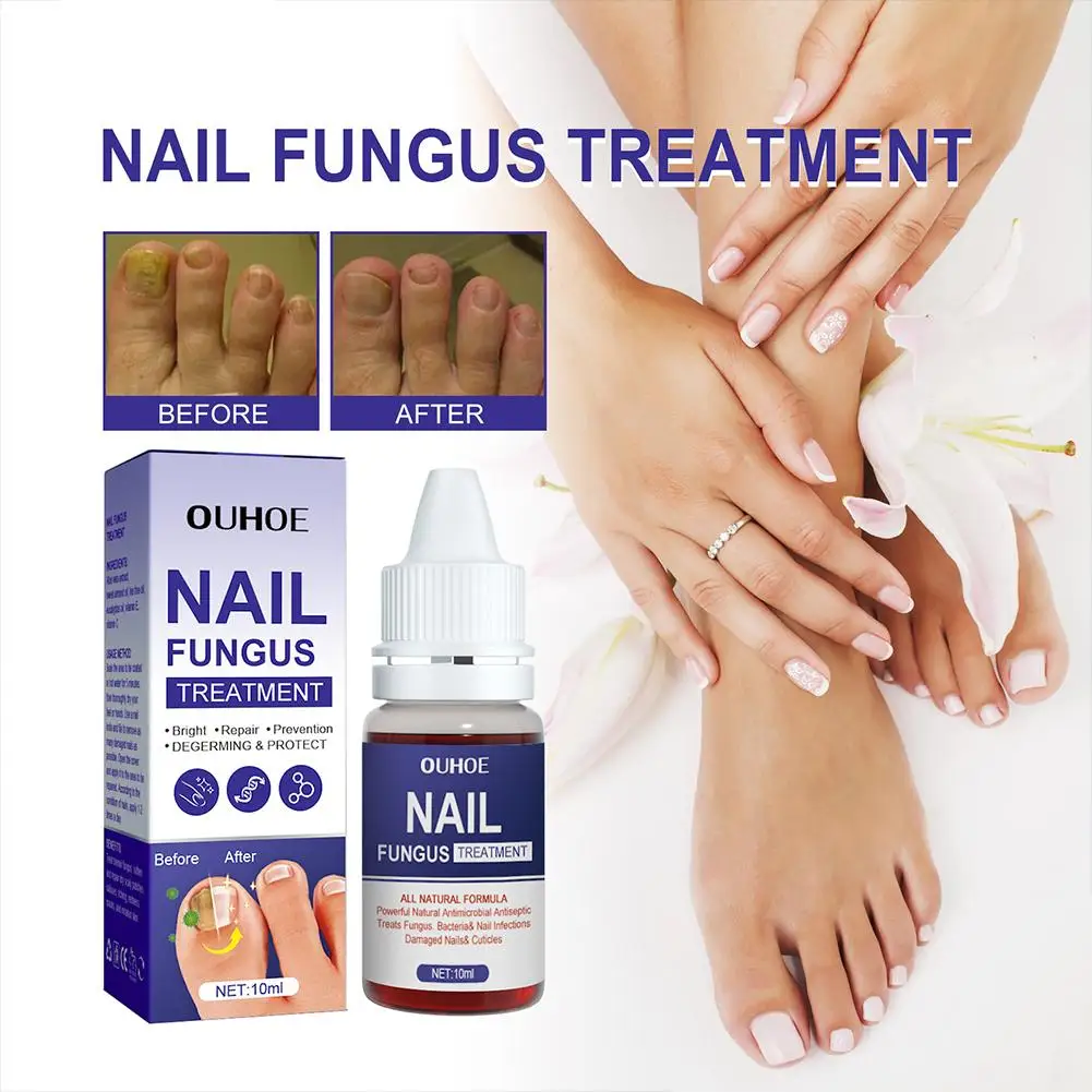 Soro de tratamento de fungos nas unhas, reparação de pés, líquido para remoção de dedos dos pés, anti-infecção, paroníquia, gel para unhas, 10ml, onicomicose i6g1