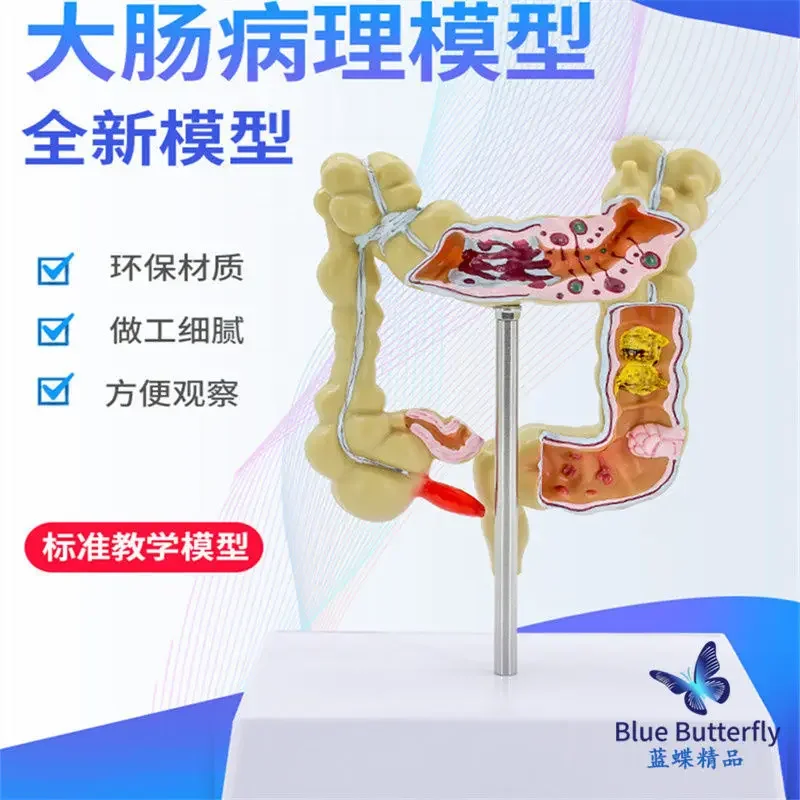 

Патологическая модель анатомической модели толстого кишечника, модель желудочно-кишечных заболеваний, модель заболеваний толстой кишки человека