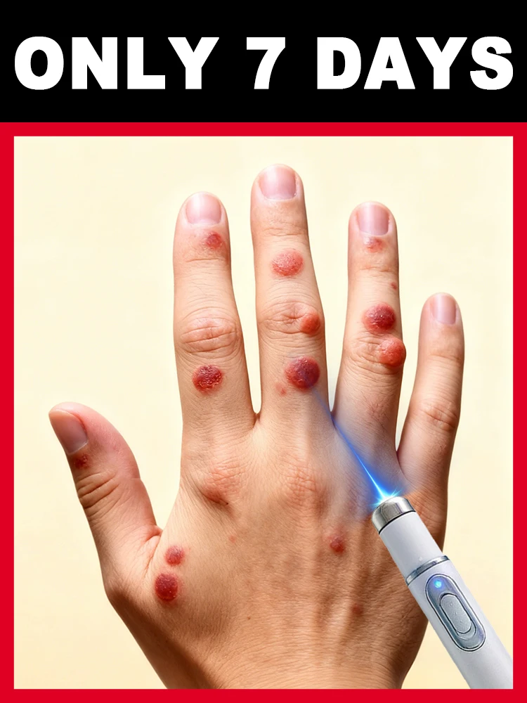 ᴸᵃˢᵉʳ ᵖᵉⁿ ᵖᵒⁱⁿᵗ ᵃᵖᵖˡⁱᶜᵃᵗⁱᵒⁿ ᵗᵒ ʳᵉᵐᵒᵛᵉ ʷᵃʳᵗˢ and reduce the risk of infection at the damaged