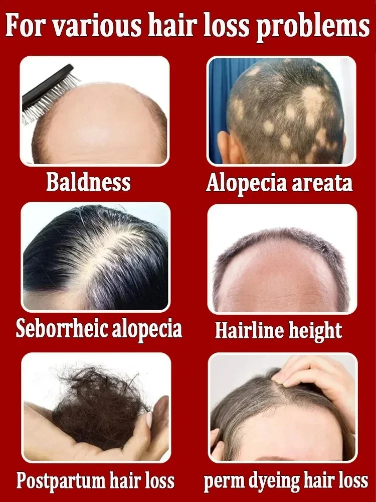 Productos para el crecimiento del cabello de biotina para hombres y mujeres, suero de jengibre anticaída, aceite de crecimiento rápido