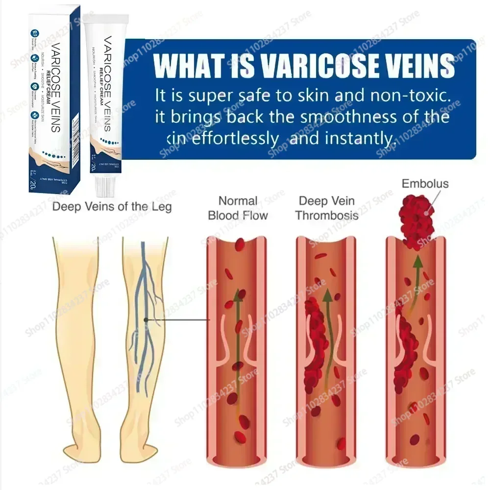 Leg Varicose Vein Repair Cream Quickly Relieves Leg Tiredness and Heaviness 0924