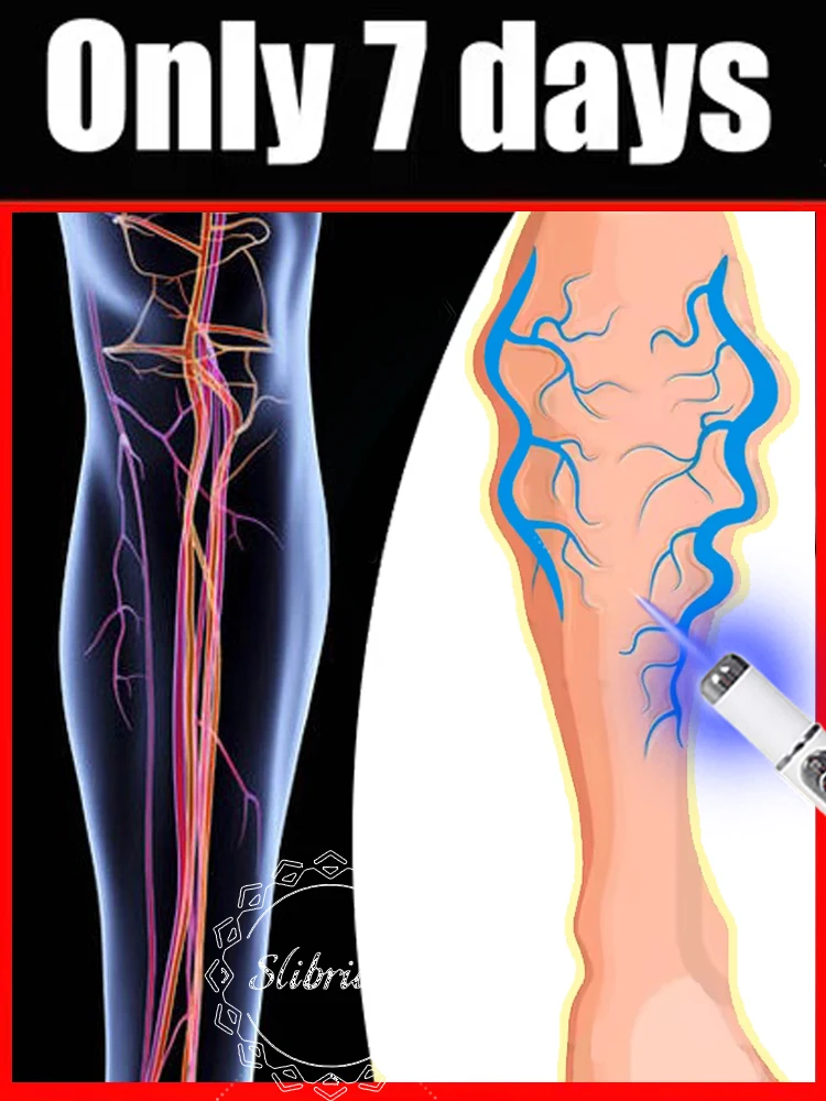 

Vein 2025 new blue light pen solve varicose veins, hot sale leg care tools