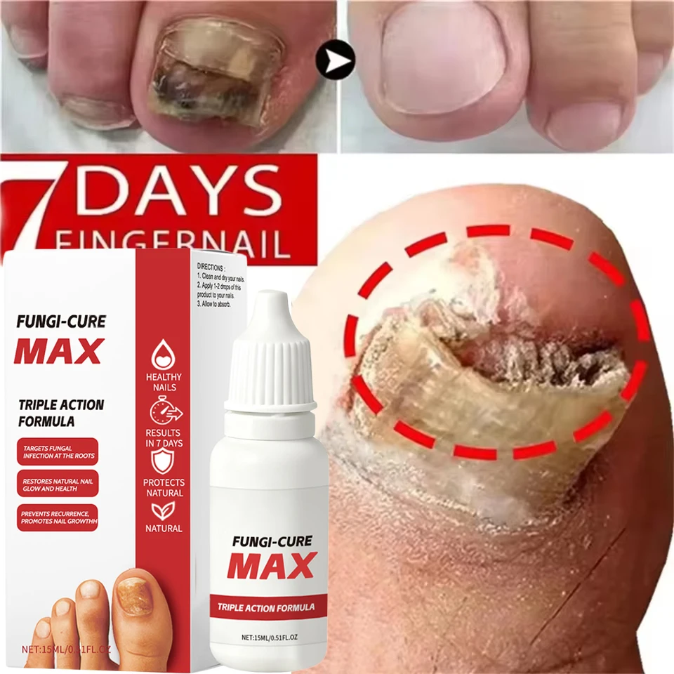 

Nail Fungus Treatment Serum Treatment Toe Nails Fungal Removal Essential Oil Anti Infection Paronychia Onychomycosis Health Care