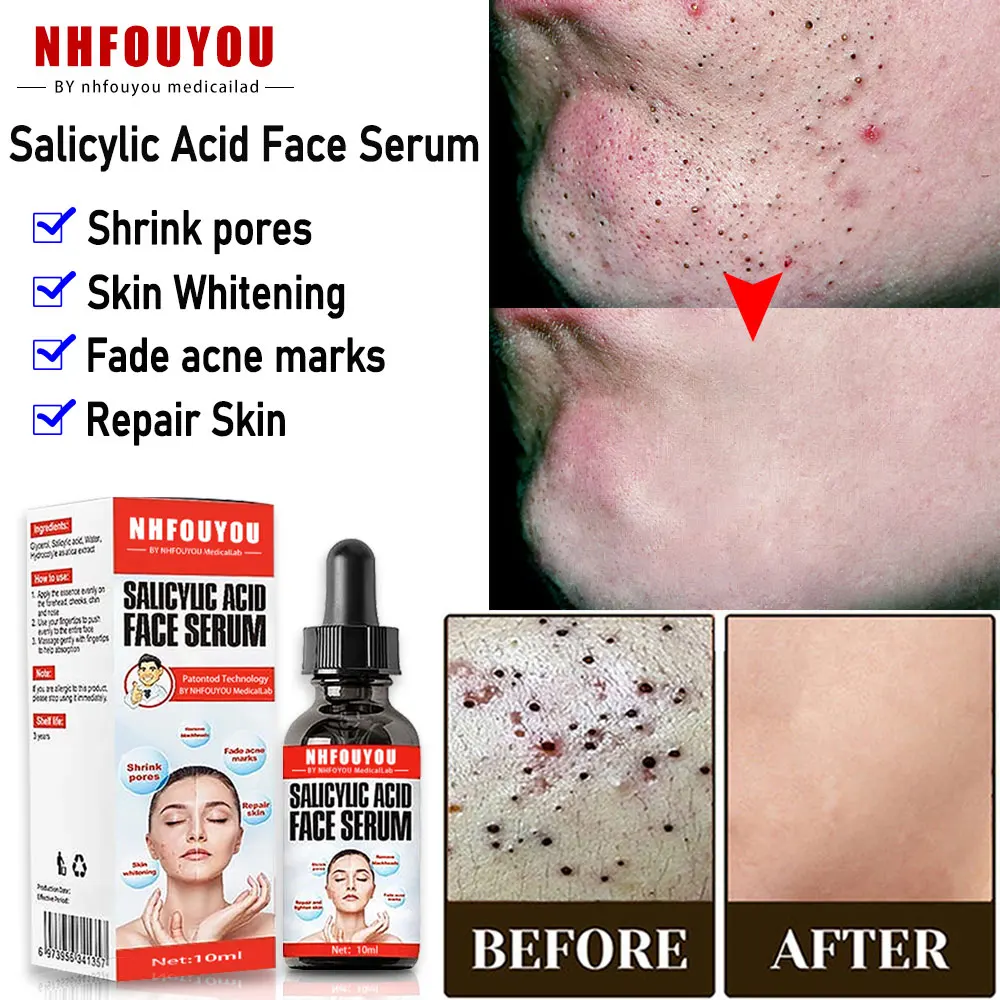 

Salicylic Acid Face Serum Shrink Firm Pore Oil Control Remove Blackhead Acne Anti Dark Spot Whitening Skin