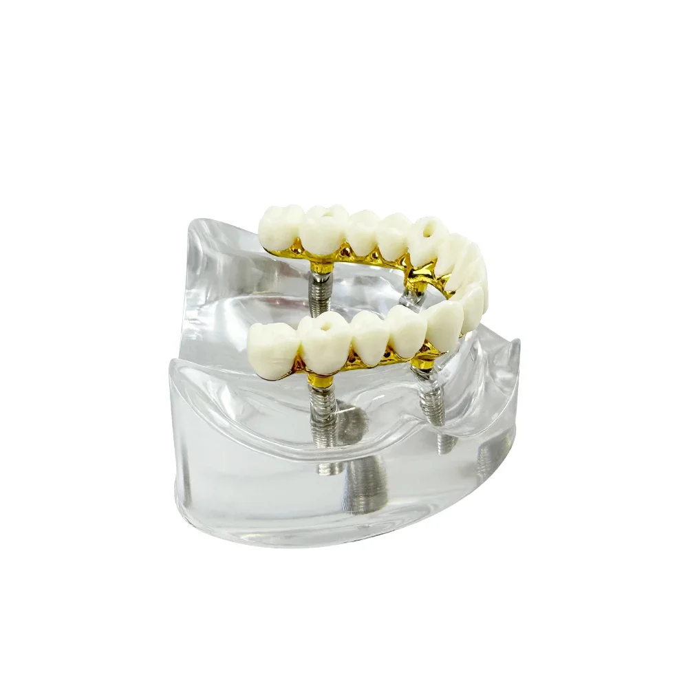 Dental Implant Model With Restoration 4 Implants Upper Jaw Removable Teeth Model Overdenture For Dentisit Teaching Demonstration