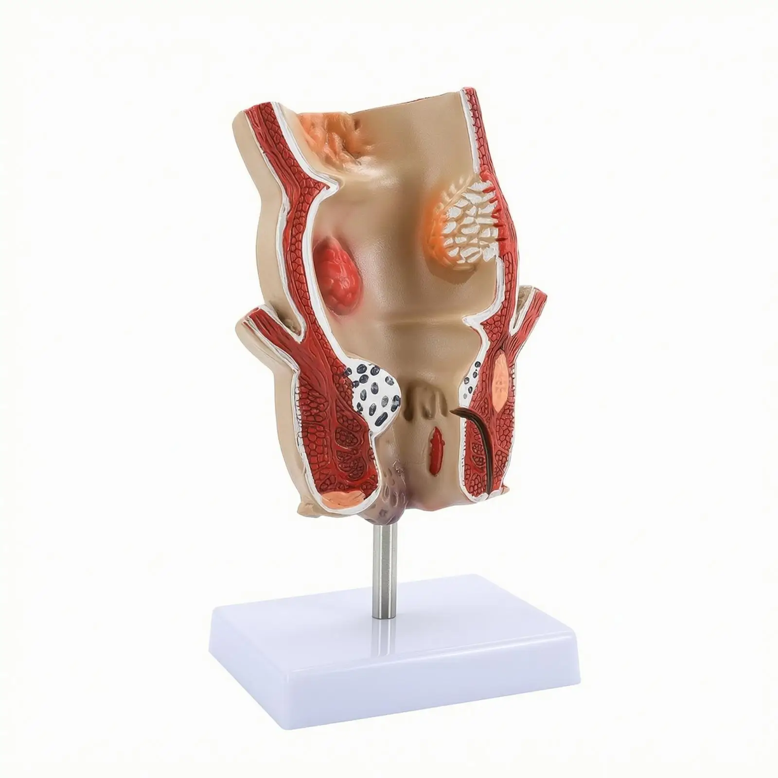 Anorectal Model with Base Hemorrhoid Model Enlarged for Teachers, Classroom